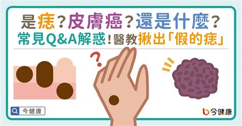 痣 生成原因|是痣？還是皮膚癌？皮膚科醫師教你揪出「假的痣」，。